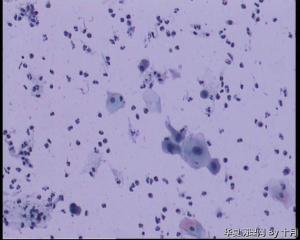 46岁，宫颈液基。化生？病变？图7