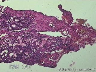 双侧鼻腔新生物图15