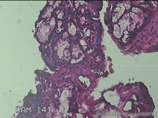 双侧鼻腔新生物图27