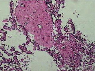 胎盘组织及部分脐带图35