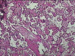 胎盘组织及部分脐带图5