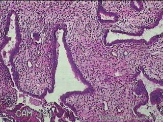 子宫腔赘生物图37