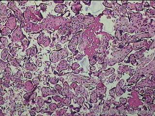 胎盘组织及部分脐带图19