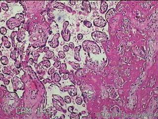 胎盘组织及部分脐带图34