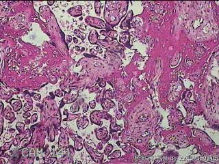 胎盘组织及部分脐带图33