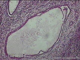 子宫腔赘生物图18