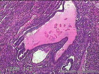 子宫腔赘生物图20