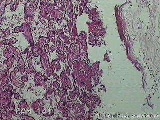 胎盘组织及部分脐带图4