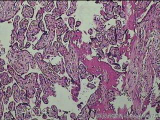 胎盘组织及部分脐带图25