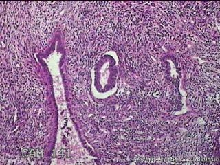 子宫腔赘生物图16