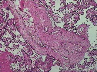 胎盘组织及部分脐带图30