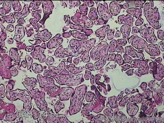 胎盘组织及部分脐带图20
