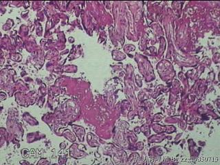 胎盘组织及部分脐带图8