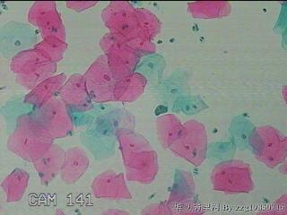 宫颈HPV感染图36