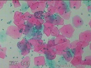 宫颈HPV感染图11