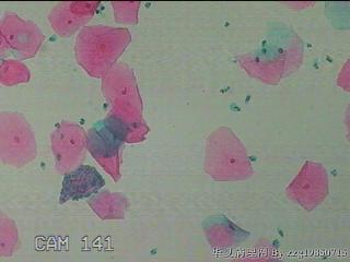 宫颈HPV感染图25