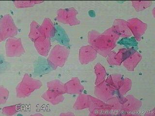 宫颈HPV感染图37