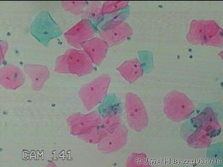 宫颈HPV感染图41