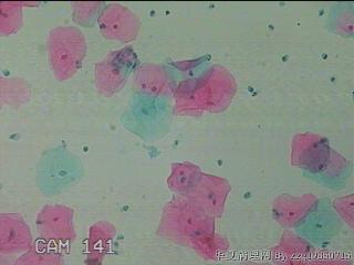 宫颈HPV感染图29