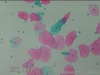 宫颈HPV感染图20