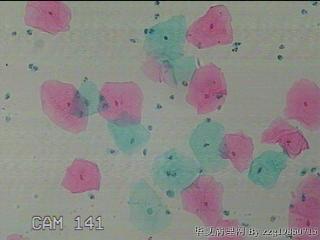 宫颈HPV感染图48