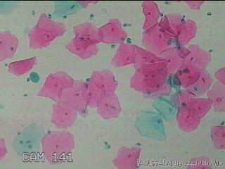 宫颈HPV感染图38