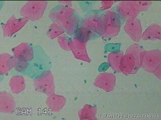 宫颈HPV感染图27