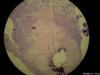 肠系膜结节图5