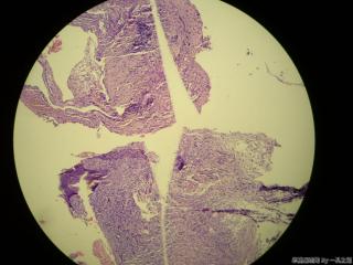 肠系膜结节图10