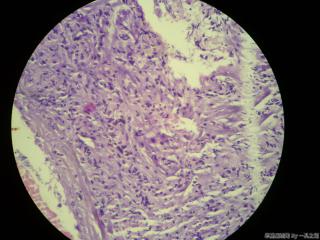 肠系膜结节图11