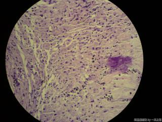 肠系膜结节图6