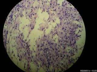 肠系膜结节图9