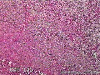 右卵巢黄体囊肿图21