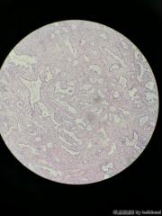 子宫内膜息肉图12