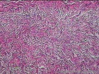 左侧卵巢囊肿组织物图18