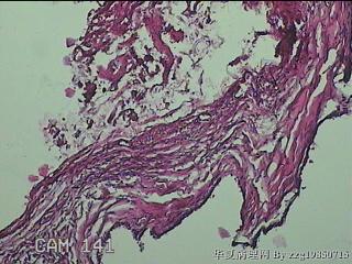 左侧卵巢囊肿组织物图37