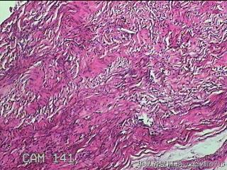 左侧卵巢囊肿组织物图14