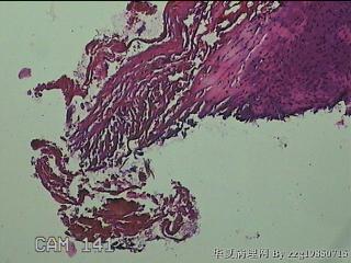左侧卵巢囊肿组织物图29
