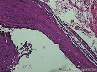 左侧卵巢囊肿组织物图25