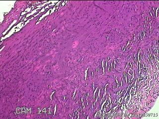 左侧卵巢囊肿组织物图27