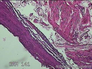 左侧卵巢囊肿组织物图24