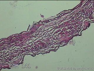 左侧卵巢囊肿组织物图36