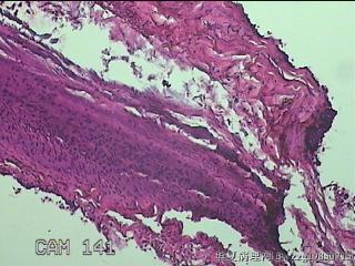 左侧卵巢囊肿组织物图2
