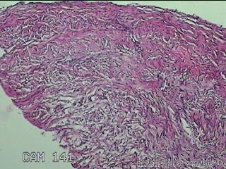 左侧卵巢囊肿组织物图40