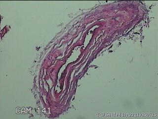 左侧卵巢囊肿组织物图10
