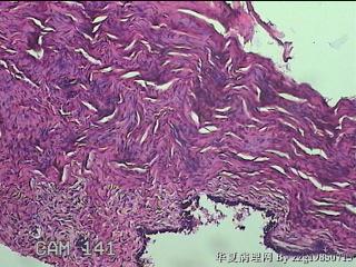 左侧卵巢囊肿组织物图22