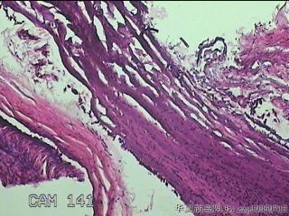左侧卵巢囊肿组织物图3