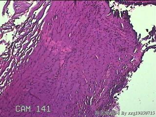 左侧卵巢囊肿组织物图26