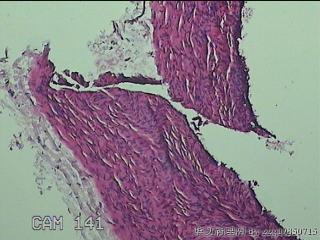 左侧卵巢囊肿组织物图6