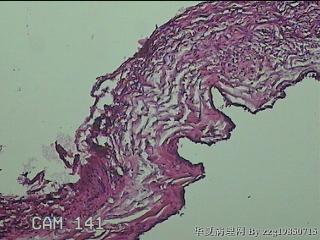 左侧卵巢囊肿组织物图34